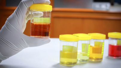 As cores da urina e suas relações com doenças e medicamentos