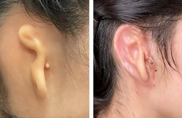 Médicos realizam transplante inédito de orelha usando impressão 3D