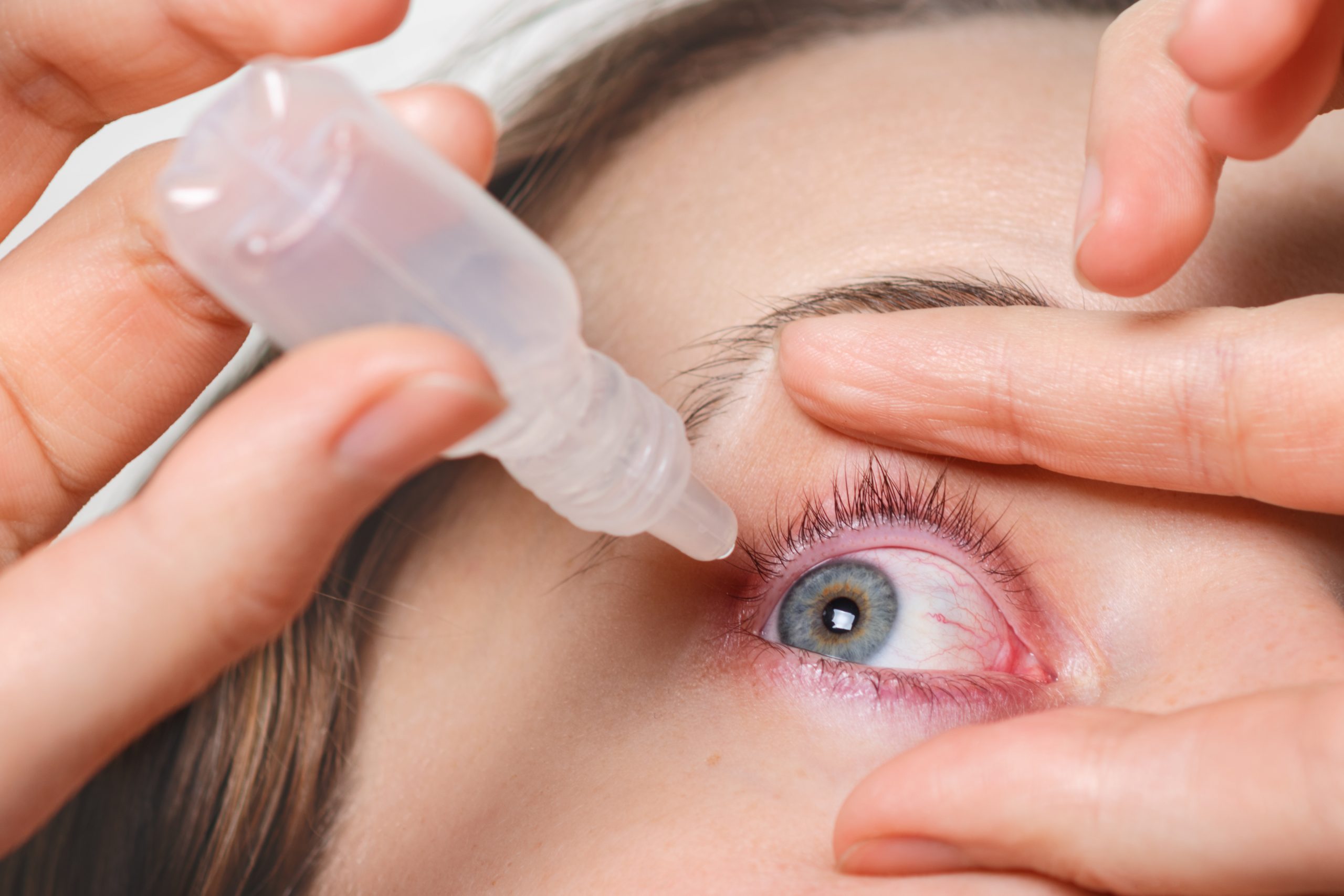 Close up shot of female pours drops in red eye, has conjuctivitis or glaucoma, bad eyesight and pain. Eyes pain treatment con